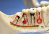 Endodontic RCT Step by step platform