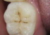 Preventive resin restorations platform