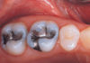 Amalgam Restorations platform