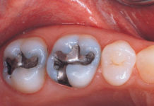 Amalgam Restorations platform