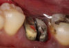 Sectioning Mandibular #6 for Extraction - Skill