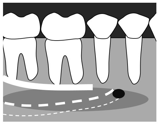 man-premolar1