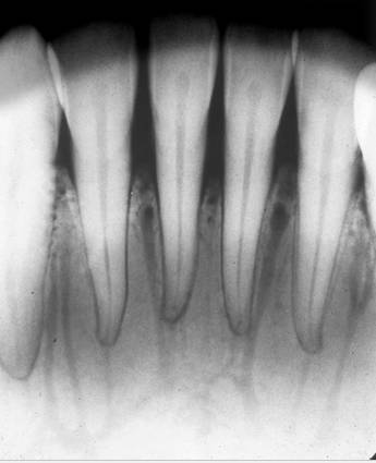 mandibular Incisor3