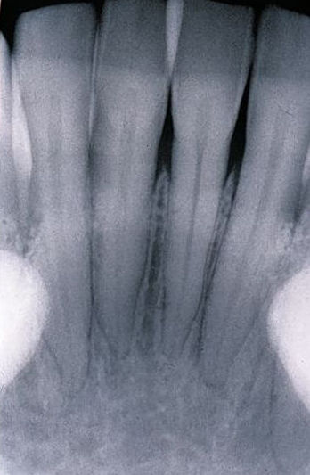 mandibular Incisor8