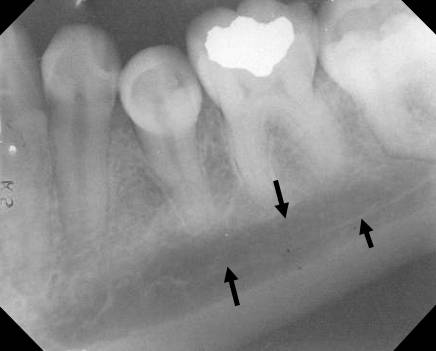 mandibular premolar2