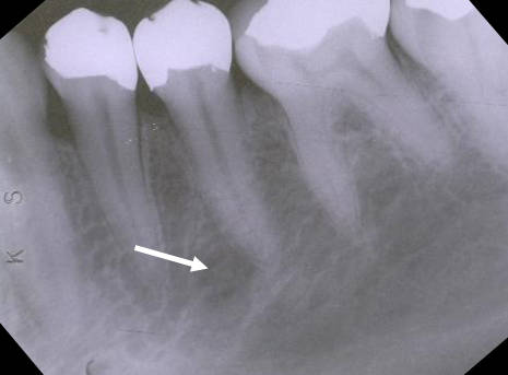 mandibular premolar4