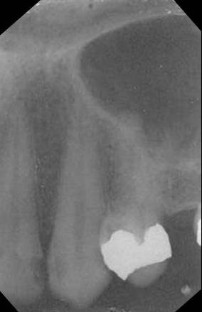 maxillary-canine1