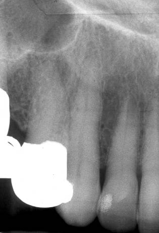 maxillary-canine2