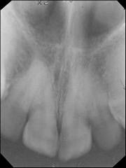 maxillary-incisor1