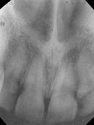 maxillary-incisor2