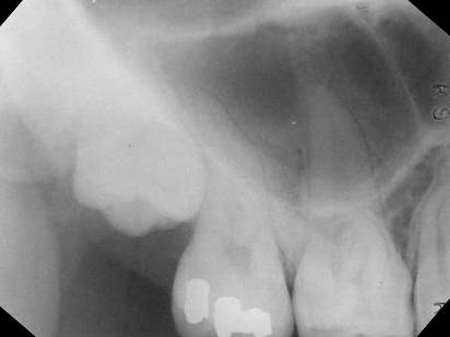 maxillary-premolars1