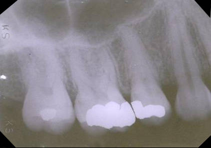 maxillary-premolars1