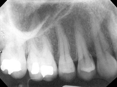 maxillary-premolars2