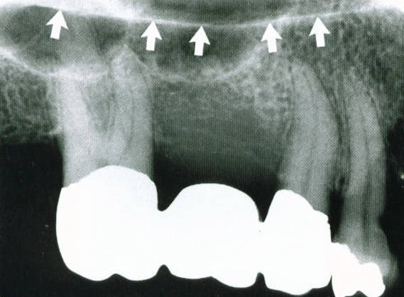 maxillary-premolars3