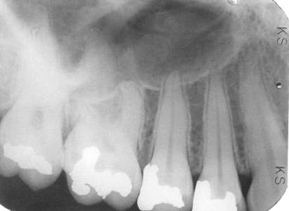 maxillary-premolars3