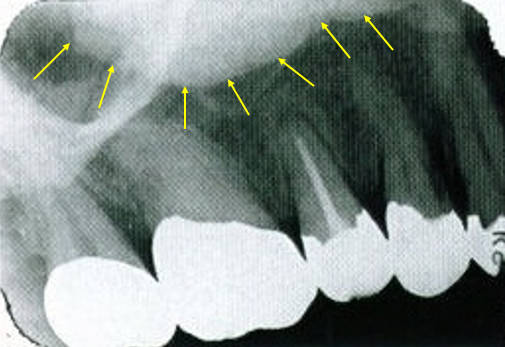 maxillary-premolars4