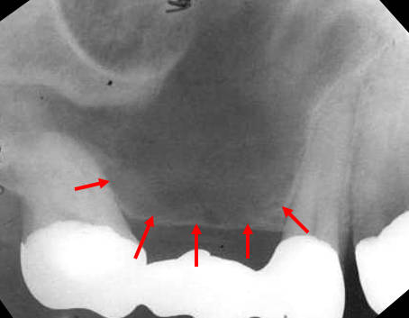 maxillary-premolars4