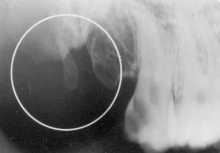 maxillary-premolars5