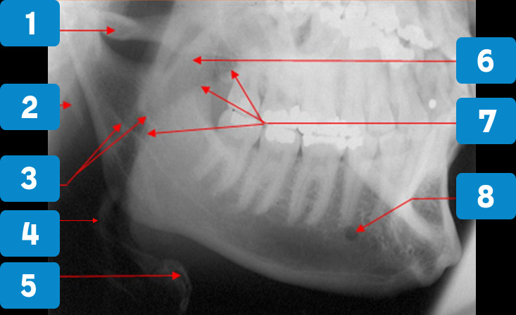 oblique-lateral-1