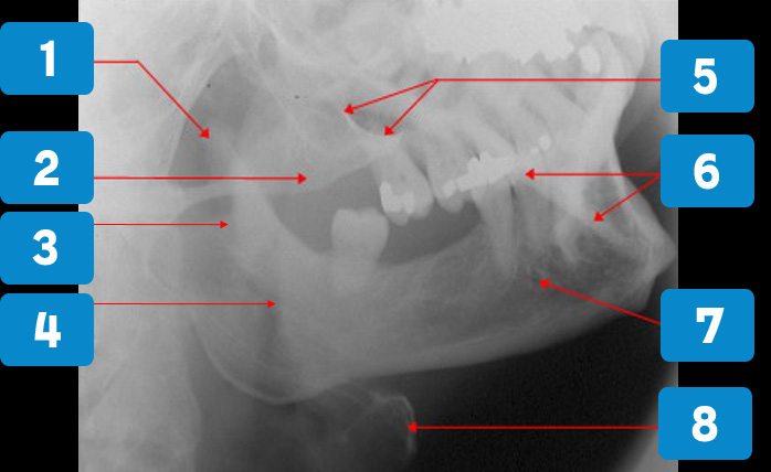 oblique-lateral-3