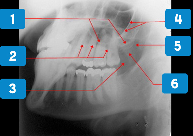 oblique-lateral-4