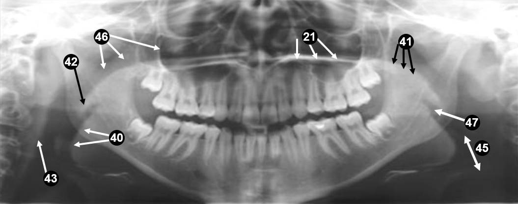 panoramic-xray3