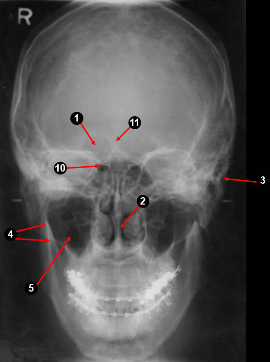 psteroanterior1