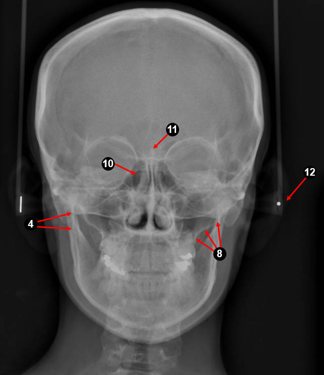 psteroanterior2