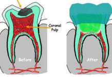 Pulpotomy in Primary teeth | Treatment