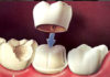 Crowns & Bridges - Dentistry online