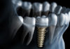 Implants - Dentistry online