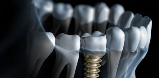 Implants - Dentistry online