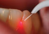 Laser in dentistry - Dentistry online