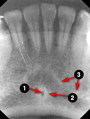 mandibular-Incisor1