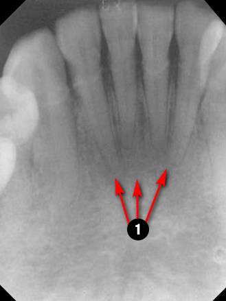 mandibular-Incisor2q