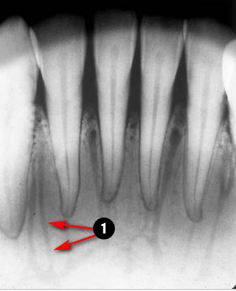 mandibular-Incisor3q