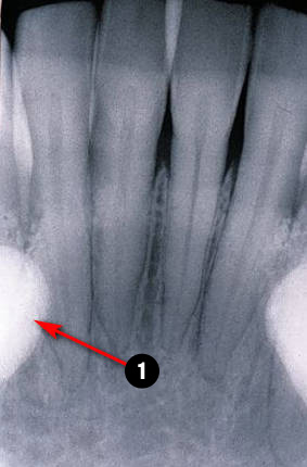 mandibular-Incisor4q