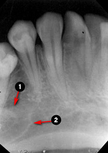 mandibular-canine5q