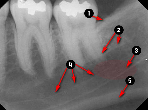 mandibular-molar1q