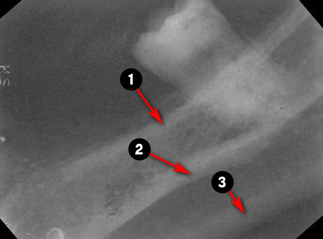 mandibular-molar2q