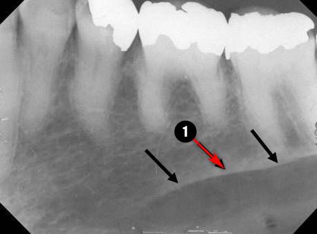 mandibular-premolar1q