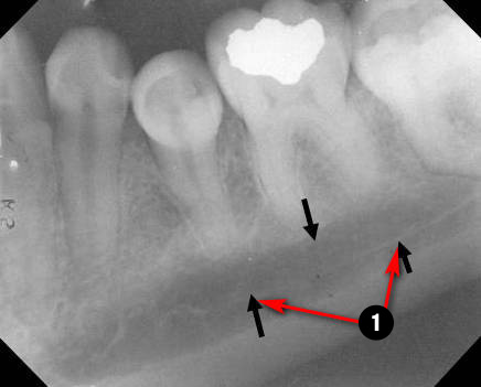 mandibular-premolar2q