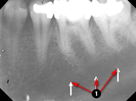 mandibular-premolar3q