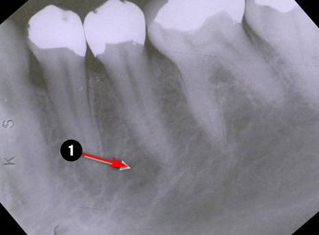 mandibular-premolar4q