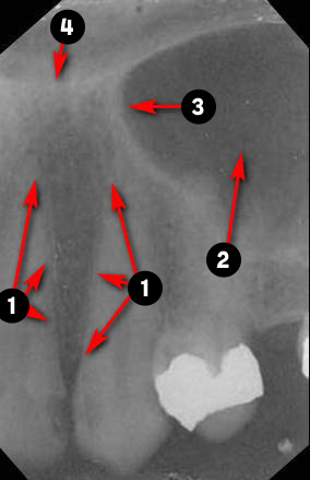 maxillary-canine1q