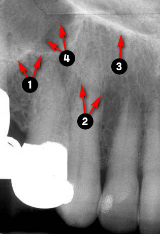 maxillary-canine2q