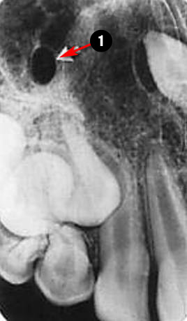 maxillary-canine3q