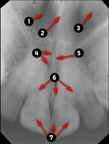 maxillary-incisor01