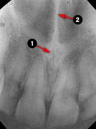 maxillary-incisor2