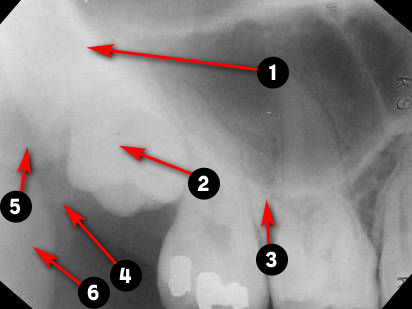 maxillary-premolars1q